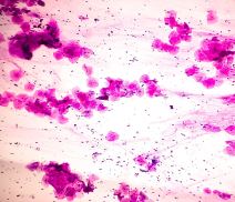 HPV ispod mikroskopa