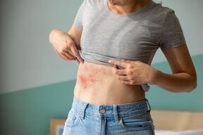 Herpes zoster