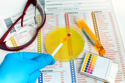 krupan plan ruke sa plavim higijenskim rukavicama koja drži tračicu za analizu urina iznad papra sa spiskom analiza