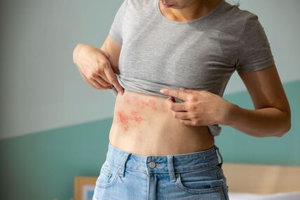 Herpes zoster