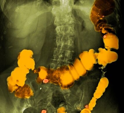 Divertikuloza