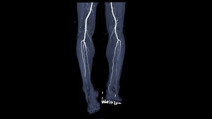 Periferna arterijska bolest