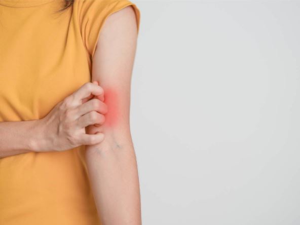 Osoba obolela od lupusa