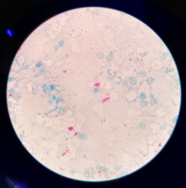 Lepra pod mikroskopom