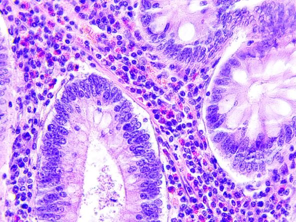 Kolorektalni karcinom pod mikroskopom