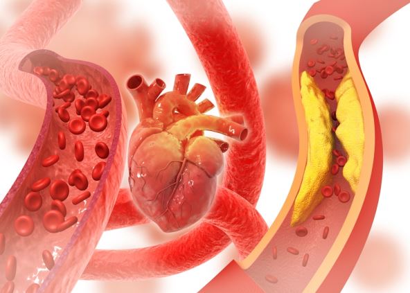 ilustracija srca i dve arterije, jedna začepljena holesterolom a druga zdrava