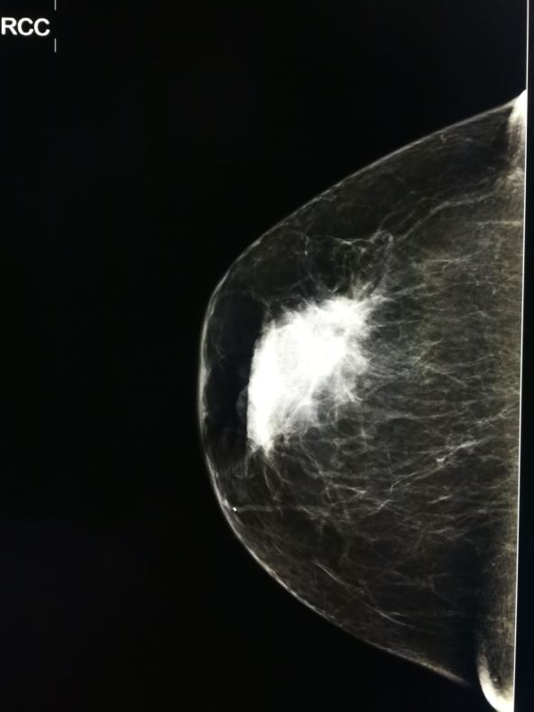 Promene u tkivu dojke