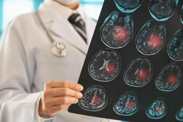 doktor u belom mantiu sa stetoskopom drži desnom rukom snimak mozga