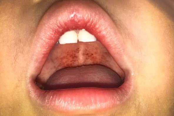 Upala grla streptokokom_1289550781.jpg