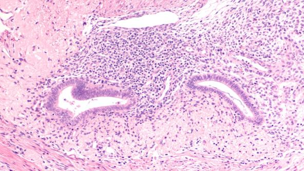 Endometrioza ispod mikroskopa