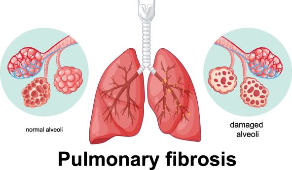 grafički prikaz zdravih pluća i pluća sa fibrozom
