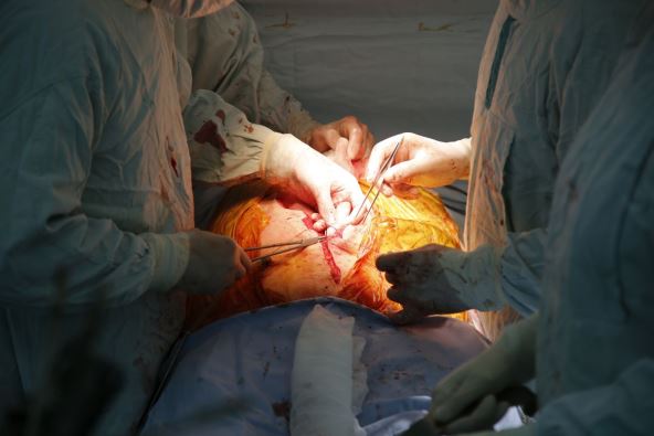 Transplatacija pluća