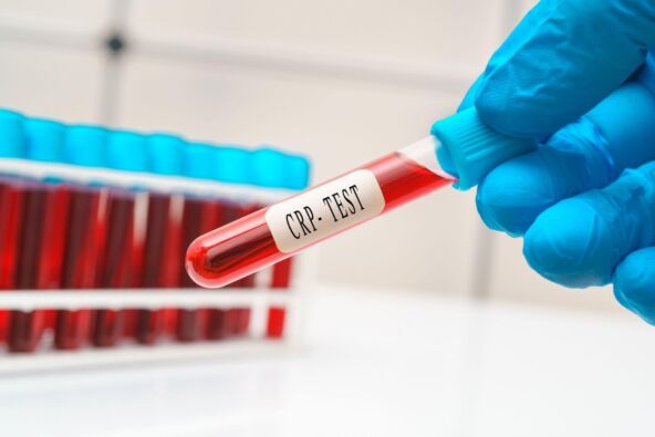 ruka laboranta drži eprivetu na kojoj piše CRP test
