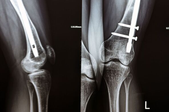 Prelom usled osteopenije