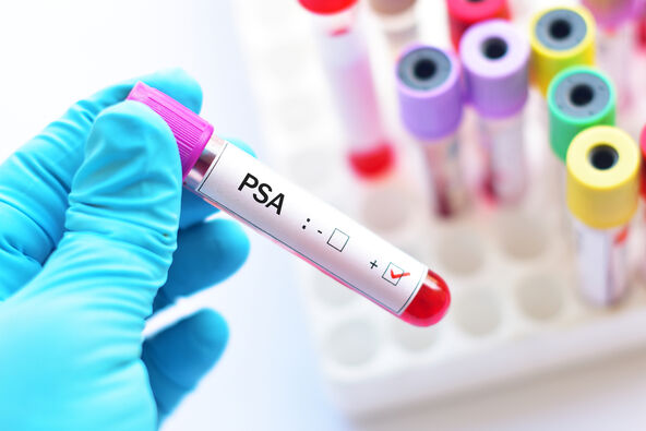 PSA test