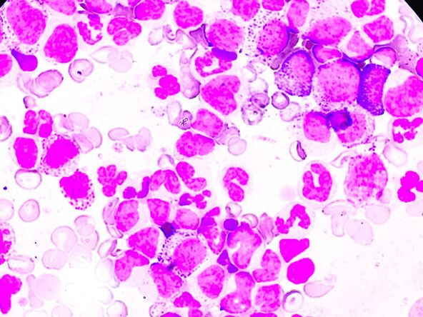 mijeloproliferativnim neoplazmama