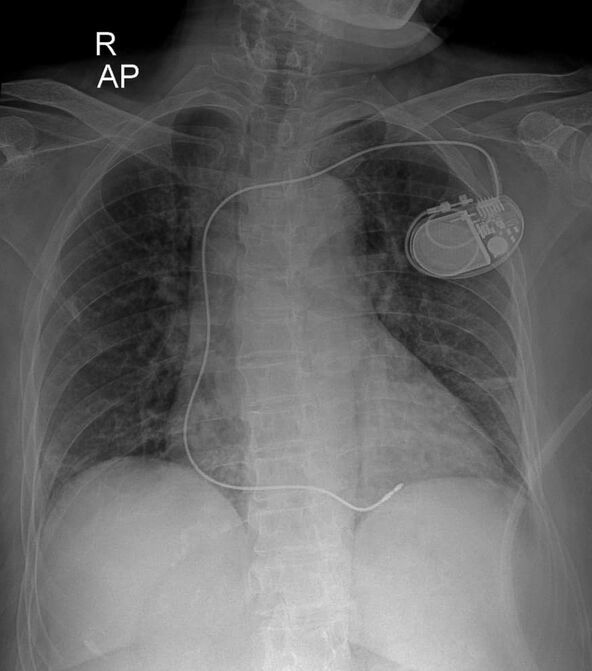 Defibrilator